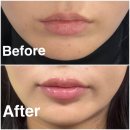 티안나의원 | 압구정 에테르나의원 입술필러+입꼬리 보톡스 후기