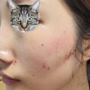 누가의원 | 수원 뉴니스의원 내돈내산 광대축소레이저 2차 솔직후기