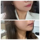 오늘더맑음의원 | 쿨페이즈 고주파 레이저리프팅 300샷 오늘맑음의원 추천 및 찐 후기