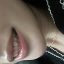 스마일 | 잇몸레이저 (잇몸성형), 거미스마일보톡스 😬🦷 후기