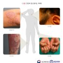 건선(psoriasis) 이미지