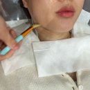 자동차피부과 | 대구동성로피부과 온다리프팅 내돈내산 솔직후기