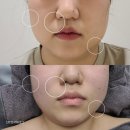 노원피부관리 결이고은 노원점 작은얼굴관리 후기