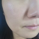 최강한의원 | 천안 여드름 흉터 전문한의원 3차 내돈내산 후기