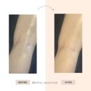 재송한의원 | [재송동/센텀 에스테틱] 하지정맥 다리 마사지