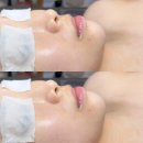 영통 슬기로운 에스테틱 스킨부스터 관리후기