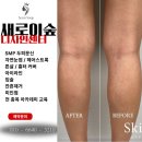 “일산 탄현동, 튼살커버로 다시 자신 있는 피부 – 새로이숲의 특별함”
