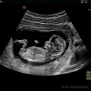 수서나을산부인과의원 | [임신12주2일차]기형아검사(수서나을산부인과),성별(딸일까),각도법,증상소화안됨,턱좁쌀여드름