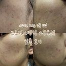 케어메디칼 | 수완지구 여드름압출 맛집 꼬모에스테틱 수완본점 메디컬 PDT 케어 후기
