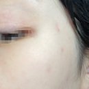 (주)에이프레이야즈 | #야즈복용 3회차, 피임약(야즈) 복용 3개월 후 턱드름 비교✅