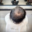 40 | 수원 링거펌 잘하는곳｜40대 남자 정수리 탈모 고민 해결 후기