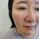 원주성형외과추천 청담심스 여드름 흉터 제거는