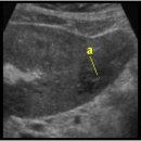 Splenic and liver abscesses 이미지