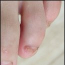 동대문구 발톱무좀?_푸스케어청량리역점 후기