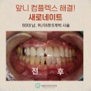 광주 라미네이트는 대표원장이 전 후 사진후기로 증명하는 치과에서 (60대 남성 사례) 의미없는 광고성...