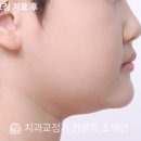페이스라인치과의원 | 장기동 걸포동 교정치과 | 치과 공포가 있던 7세 반대교합, 악궁확장·페이스마스크 8개월 변화