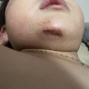 박종필성형외과 네이버블로그