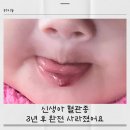 자라다의원 | 신생아 혈관종 3년 후 후기｜입술 혈관종 약·주사·레이저 치료 과정 정리