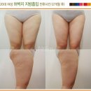 전신 지방흡입(허벅지,팔,복부)/25세(여성)/160cm/84kg-＞72.9kg(총11.1kg감량) 이미지