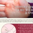 발바닥 물집 새끼 발가락 발에 물집 생겼을때 터뜨리기 : 원인 연고 대법 이미지