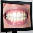 치과다운 치과의원 | 이제 웃을 때 자신감 뿜뿜! H플란트치과의원 다녀온 찐 후기 들어갑니데이~