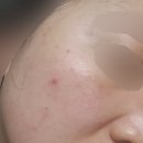 코슈마드 | 홍조여드름 탈출 시도 홈케어 1일차~코슈마드 초음파LDM