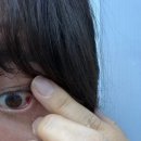 삼성더드림 | 신도림 삼성드림안과 진료 후기｜눈 실핏줄 터짐, 안압·시신경 검사 결과와 관리법