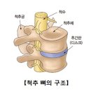요추 추간판 탈출증 (Herniation of intervertebral disk) 이미지