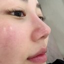 예쁨주의쁨성형외과의원 | 서면쁨의원에서 서면 릴리이드주사, 아쿠아필, 물광주사 내돈내산 후기