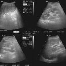 Severe hydronephrosis etc... 이미지