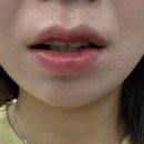 참이비인후과의원 | [금정이비인후과의원후기] 순수 내돈내산 구내염 치료