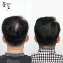 정수리 | 남자 정수리 탈모 두피문신 후기 시술 과정
