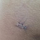 하라라성형외과의원 | [내돈내산] 마포공덕 피지낭종 제거수술 후기 - 힐링성형외과