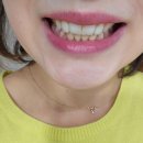 [청주치아미백] 교정 후 치아미백 솔직 후기 (+10일 후 사진) :: 청주가경동치과