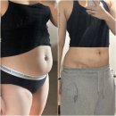 되지 생활건강 | 복부지흡 후기 한달 : 지방흡입전후, 실밥제거, 일상생활