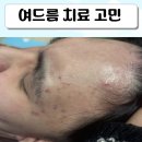 리멤버피부과의원 - 의정부시 오목로225번길 162 | 내돈내산 여드름고민 리멤버피부과 여드름스케일링 1회 후기