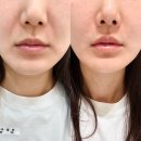 결혼 준비를 하긴 하는구나.. 서면 쥬베룩 볼륨 + 스킨보톡스 내돈내산 후기