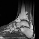 대조-009 | Effect of Early Versus Late Weightbearing in Conservatively Treated Acute Achilles Tendon Rupture: