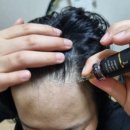 모발이식 가격이 부담스러울땐 오지헌 리맨틱 탈모 줄기세포 배양액 홈케어 앰플 하세요