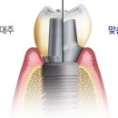 덴토피아치과 네이버블로그