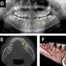 당신e빛나는 치과의원 | 치아종이란? 증상부터 치료까지, 판교교정치과에서 알려드립니다