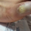 소천약국 | 집에서 티눈 제거 후기 신신 티눈밴드, 고닐고 내돈내산 밴드VS용액