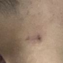 하태원성형외과의원 | 함희정 성형외과 튀어나온 점 흉터 제거 후기 -2 (마지막!!)