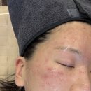 신사역 잠원피부과 온다리프팅6만줄 효과 + 미백 스킨부스터 엘리쥬 후기 (리프팅 피부과 추천)