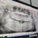 아시아드치과의원 | 치과치료1) 오른쪽 매복 사랑니 발치