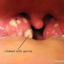 편도염 원인 (급성,만성) 대처법 이미지