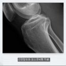 30세 남자/오스굿씨병 (Osgood-Schlatter Disease)치료 이미지