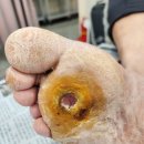 한빛메디칼 | [공지] 당뇨병성 족부궤양 빠른 회복을 위한 고압산소치료 후기