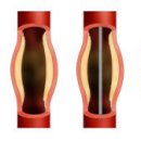 심근경색증 myocardial infarction 이미지