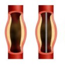 ★ 심근경색증 myocardial infarction 이미지